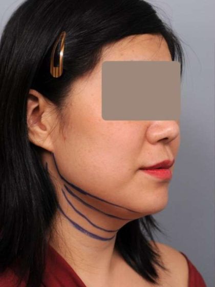 Neck Liposuction / Chin Liposuction Before & After Patient #2051