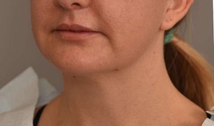 Buccal Fat Removal Before & After Patient #2080