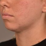 Buccal Fat Removal Before & After Patient #2085