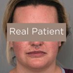 Buccal Fat Removal Before & After Patient #2108