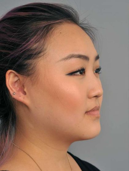 Buccal Fat Removal Before & After Patient #2118