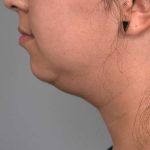 Buccal Fat Removal Before & After Patient #2127