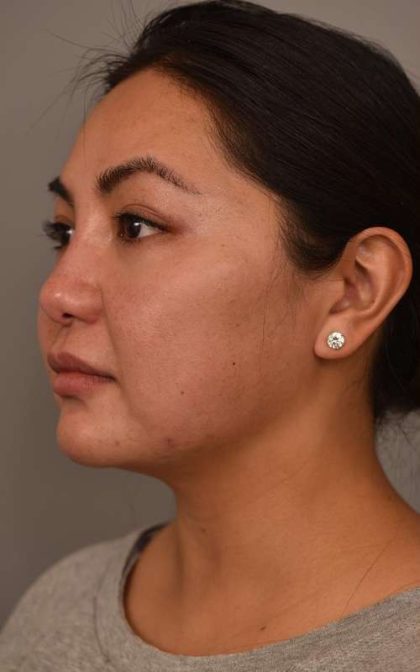 Cheek Liposuction Before & After Patient #2136
