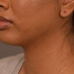 Cheek Liposuction Before & After Patient #2144