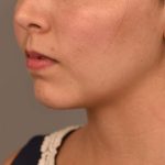 Cheek Liposuction Before & After Patient #2149