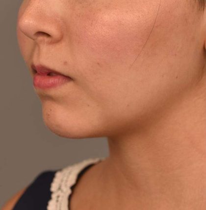 Cheek Liposuction Before & After Patient #2149