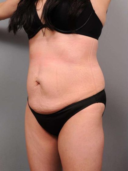 Tummy Tuck Before & After Patient #418
