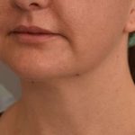 Cheek Liposuction Before & After Patient #2165