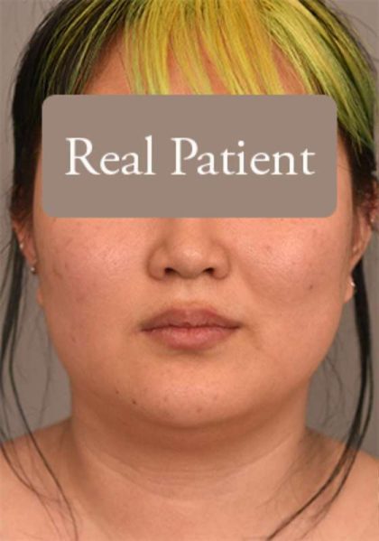 Cheek Liposuction Before & After Patient #2179