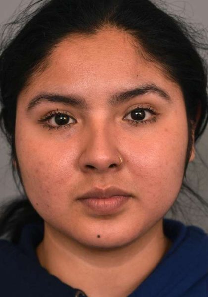Cheek Liposuction Before & After Patient #2186
