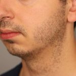 Chin Implant Before & After Patient #2203