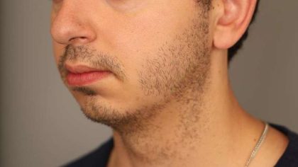 Chin Implant Before & After Patient #2203