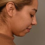 Chin Implant Before & After Patient #2210