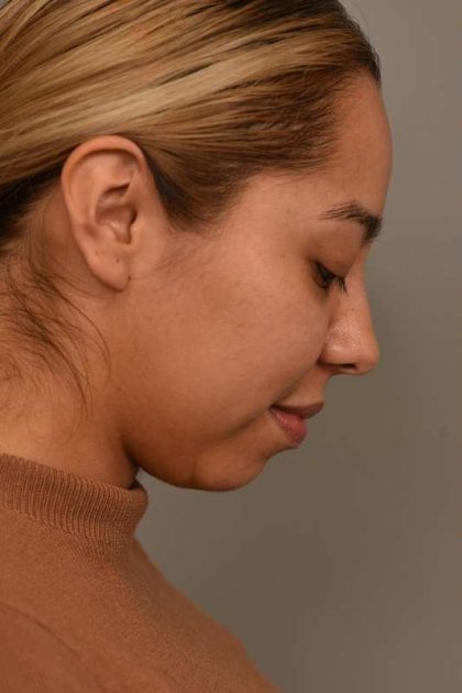 Chin Implant Before & After Patient #2210