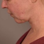 Chin Implant Before & After Patient #2220