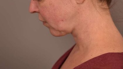 Chin Implant Before & After Patient #2220