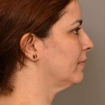 Chin Implant Before & After Patient #2227