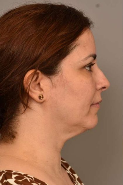Chin Implant Before & After Patient #2227