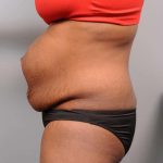 Tummy Tuck Before & After Patient #427