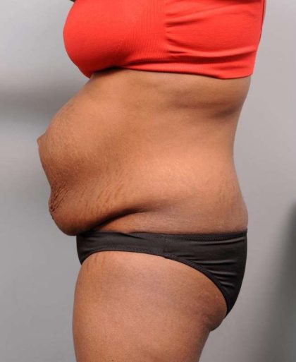Tummy Tuck Before & After Patient #427