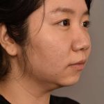 Chin Implant Before & After Patient #2234