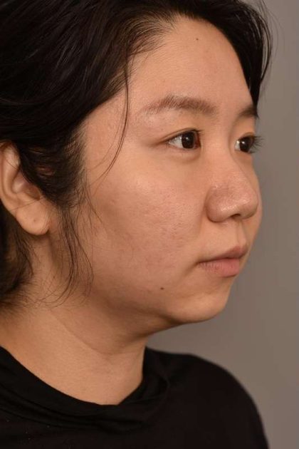 Chin Implant Before & After Patient #2234