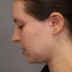 Chin Implant Before & After Patient #2243