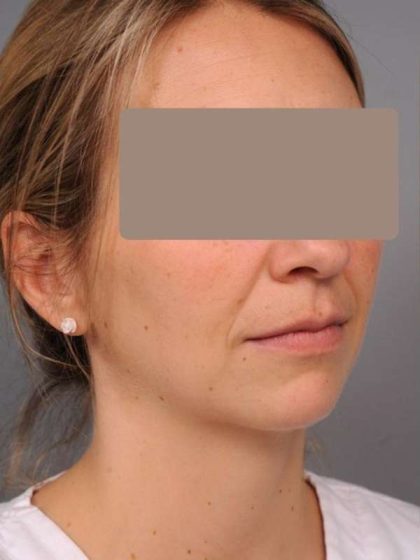 Chin Implant Before & After Patient #2253