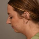 Chin Implant Before & After Patient #2262