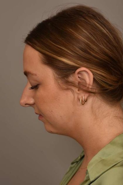 Chin Implant Before & After Patient #2262