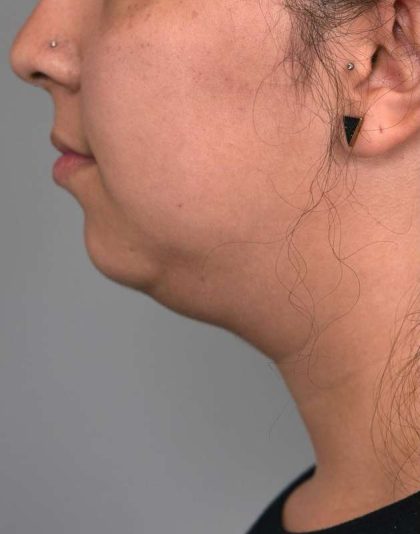 Chin Implant Before & After Patient #2278