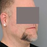 Liposuction For Men Before & After Patient #2308