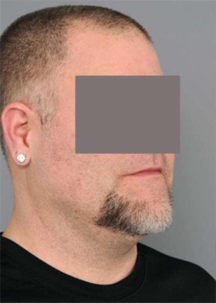 Liposuction For Men Before & After Patient #2308