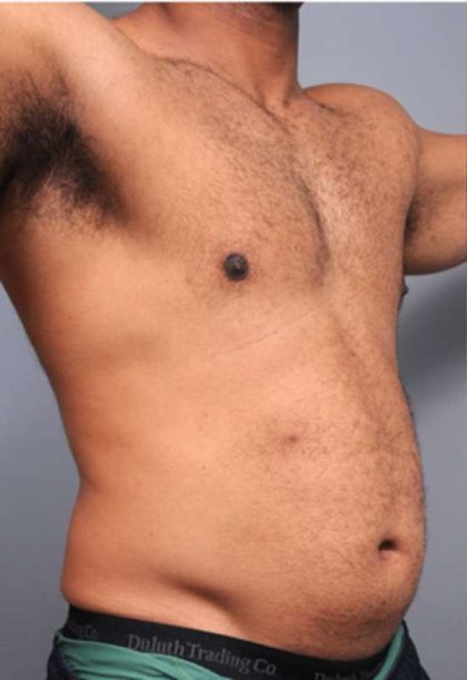 Liposuction For Men Before & After Patient #2315