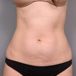 Tummy Tuck Before & After Patient #436