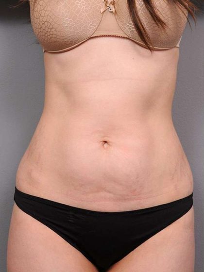 Tummy Tuck Before & After Patient #436