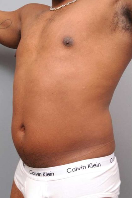 Liposuction For Men Before & After Patient #2330