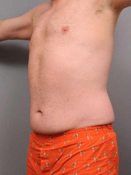 Liposuction For Men Before & After Patient #2337