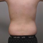 Liposuction For Men Before & After Patient #2342