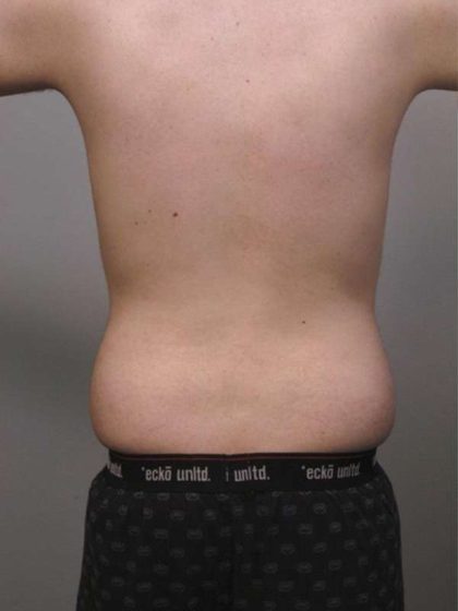 Liposuction For Men Before & After Patient #2342