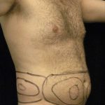 Liposuction For Men Before & After Patient #2347