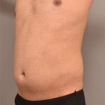 Liposuction For Men Before & After Patient #2358
