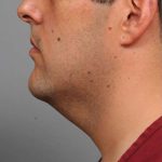 Neck Liposuction For Men Before & After Patient #2408