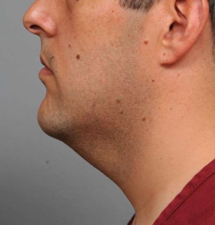 Neck Liposuction For Men Before & After Patient #2408