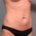 Tummy Tuck Before & After Patient #443