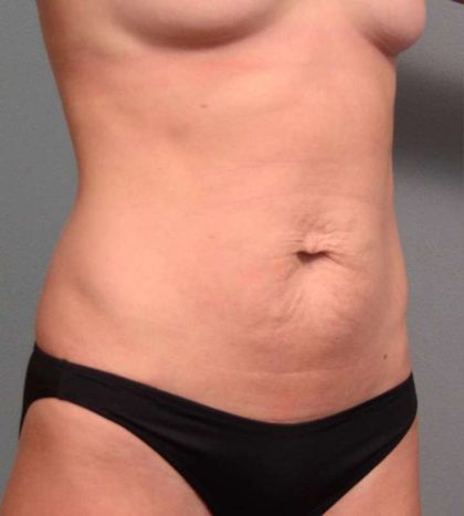 Tummy Tuck Before & After Patient #443