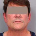 Neck Liposuction For Men Before & After Patient #2419