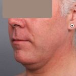 Neck Liposuction For Men Before & After Patient #2426