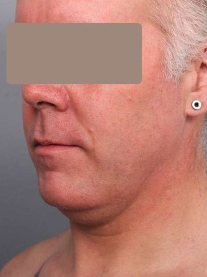 Neck Liposuction For Men Before & After Patient #2426