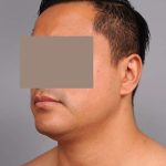 Neck Liposuction For Men Before & After Patient #2438